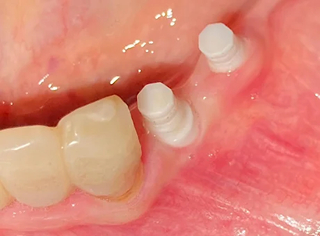 Имплантаты Cerera - результаты имплантации